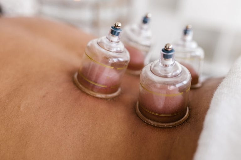 Köpölyök alkalmazása hátkezelés során – illusztráció